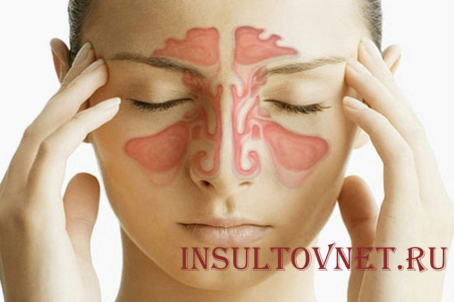 Лобные боли при гайморите