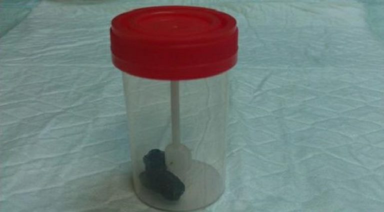 анализ кала