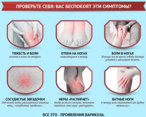 Признаки наличия варикоза на ногах