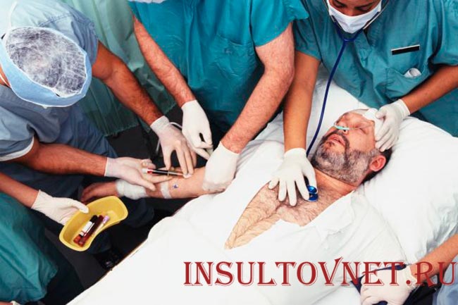 Тяжелая форма инсульта