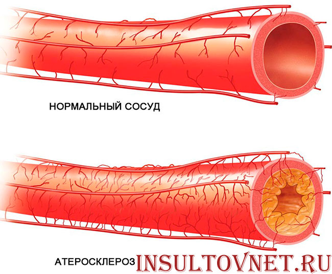 атеросклероз сосудов
