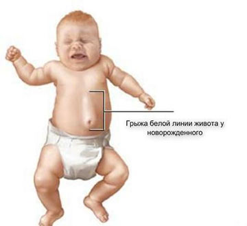 Отличия грыжи белой линии живота от пупочной у детей