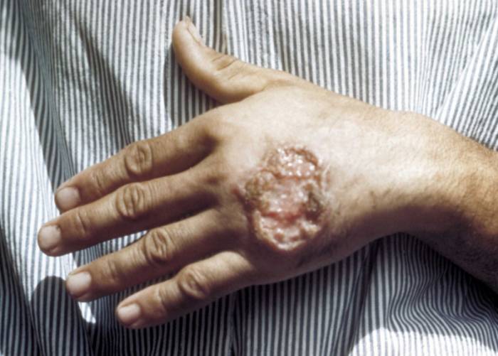 кожный амебиаз