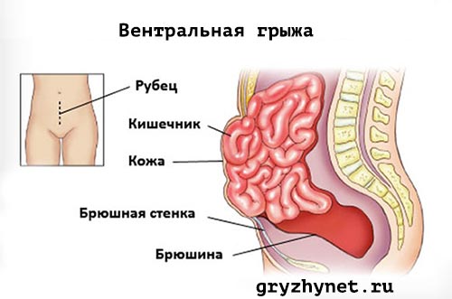 Все о вентральных грыжах. Из за чего они появляются и как с ними бороться
