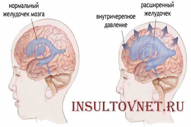 Измерение внутричерепного давления