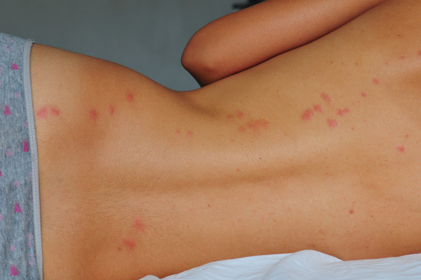 как лечить чесотку беременным