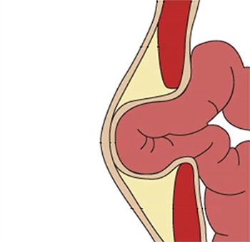 Всё о мышечных грыжах всех частей тела человека
