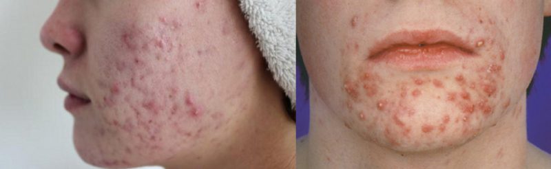 демокедоз на лице