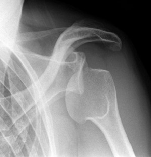 Рентген вывиха плеча Вывих плечевого сустава на рентгеновском снимке