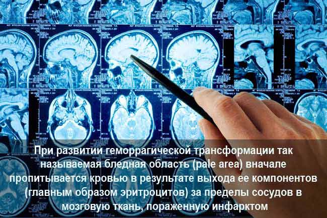 Геморрагическая трансформация ишемического инсульта
