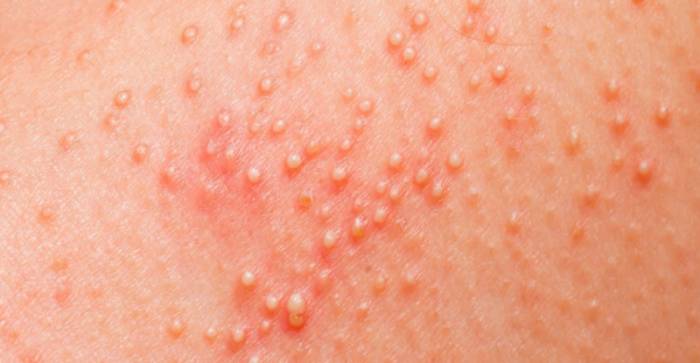 кожная сыпь