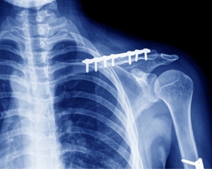 Остеосинтез Остеосинтез проводится для соединения кости при ее переломе и смещении отломков