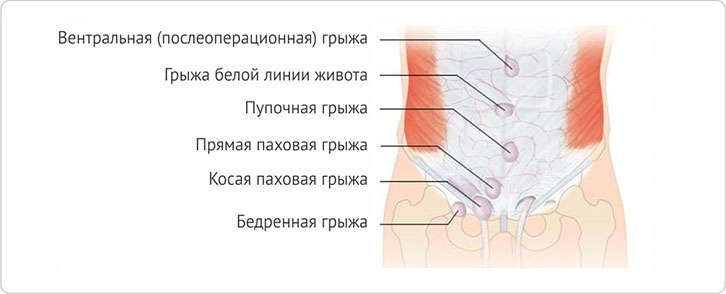 Грыжа кишечника - виды, причины развития, симптомы, способы лечения