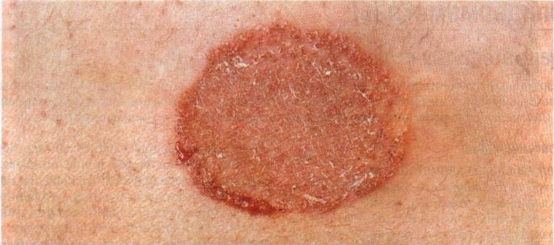 рана на теле