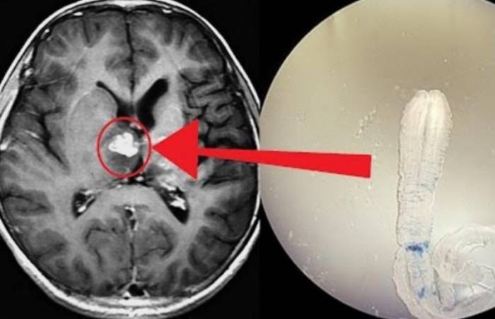 Гельминты в голове