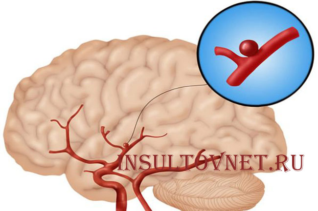 Аневризма сосудов мозга