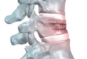 Перелом позвонка Компрессионный перелом поясничного отдела позвоночника
