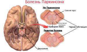 Симптомы болезни Паркинсона