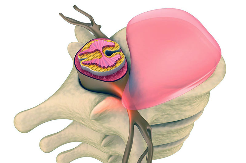 Основные симптомы и виды межпозвоночных грыж