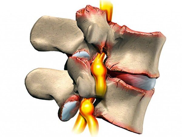 на рисунке - пример защемления в позвоночнике