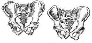 Перелом седалищной кости Изолированный перелом седалищной кости
