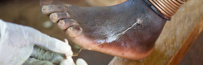 Лечение дракункулёза