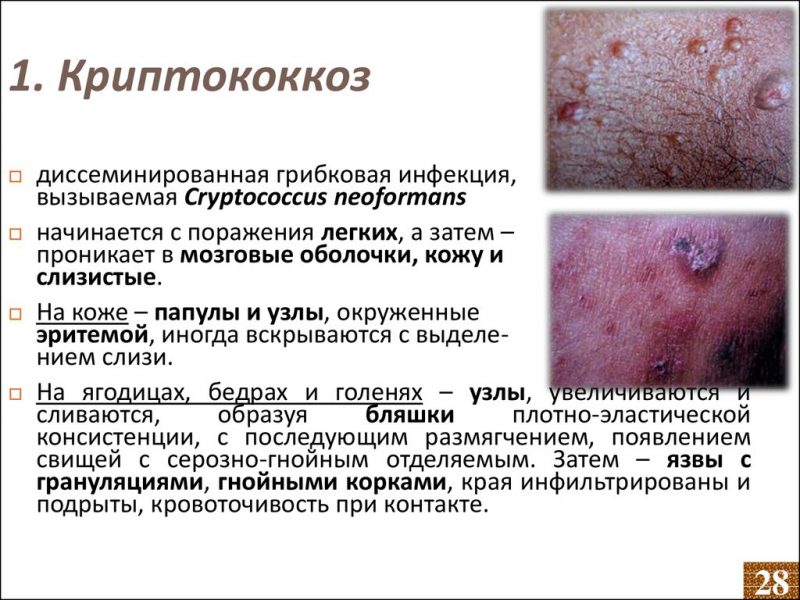 Криптококкоз