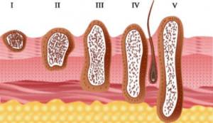 Развитие рака кожи