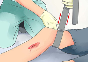 Наложение жгута Если наблюдается сильное кровотечение, нужно наложить жгут