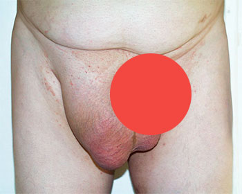 Лечение пахово мошоночной грыжи операцией и без неё