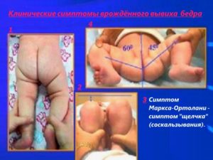 Клинические симптомы врожденного вывиха бедра Симптомы дисплазии у грудных детей