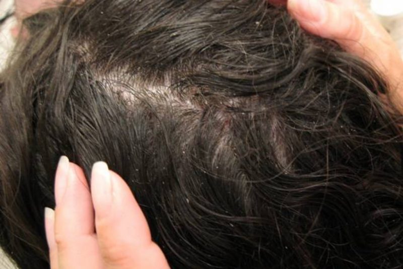 Причины педикулеза