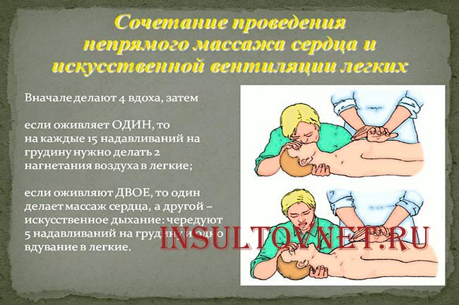 Непрямой массаж сердца