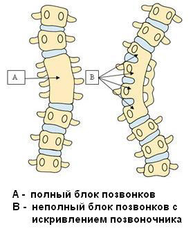 Сращение позвоночника Сращение позвонков после компрессионного перелома