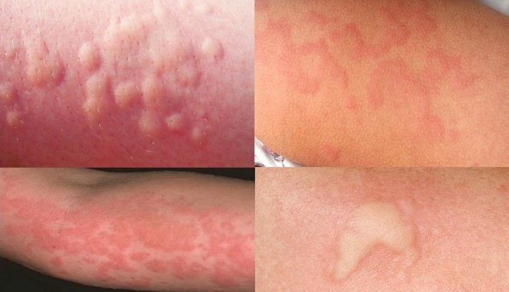 аллергические реакции на глистов