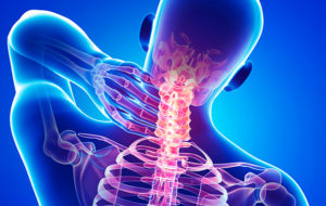 Вывих шеи Шейные позвонки