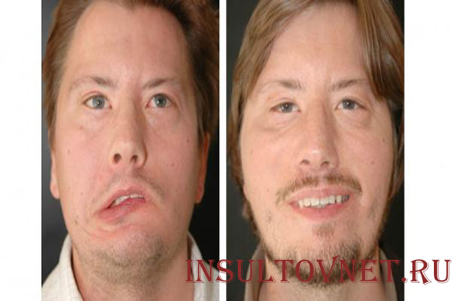 Паралич мышц лица