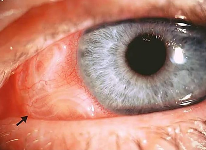 Тениаринхоз тениаринхоз