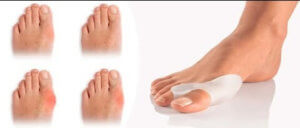 Пластины от косточек на ноге лечение