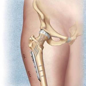 Внутрикостный остеосинтез Внутрикостный (интрамедуллярный) остеосинтез