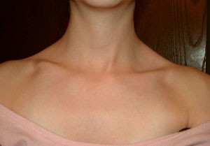 Костное образование Костная мозоль