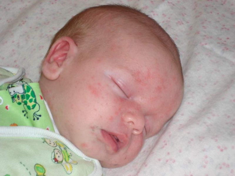 инкубационный период при поражении золотистым стафилококком