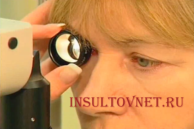 Лечение глазного инсульта