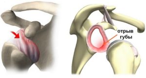 Отрыв хрящевой губы Отрыв хрящевой губы при привычном вывихе плеча