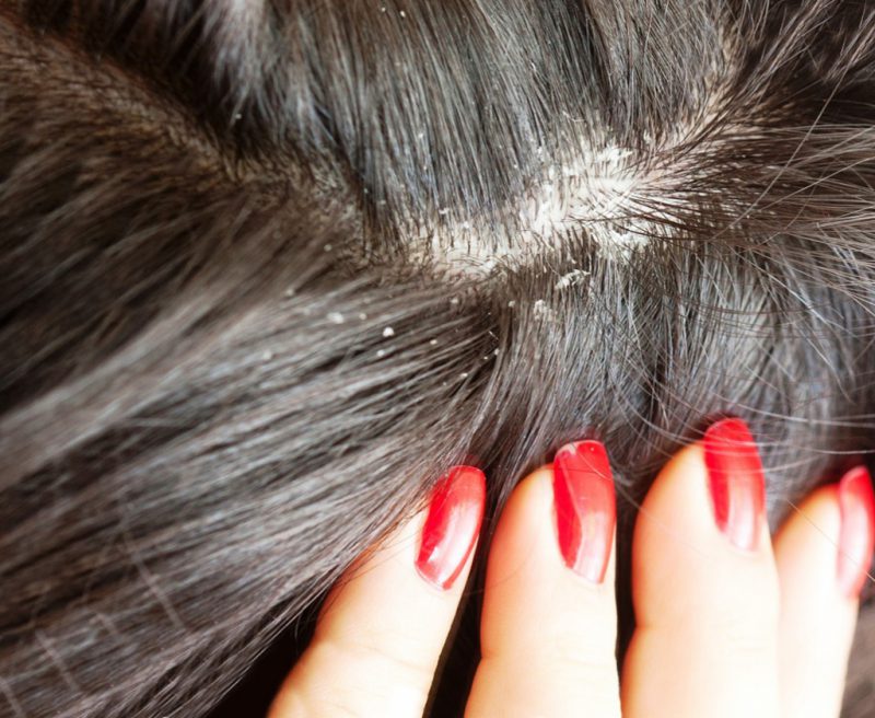 перхоть кусочками