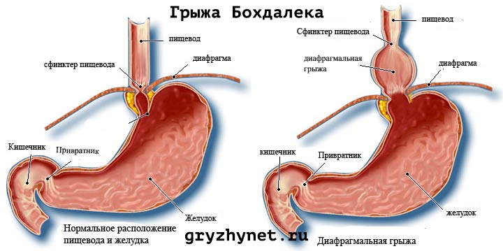 Что такое грыжа Бохдалека