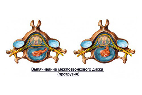 Что такое протрузия межпозвонковых дисков и лучшие методы их лечения