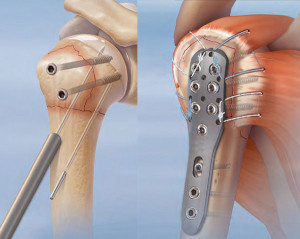 Плечевая кость Титановая пластина