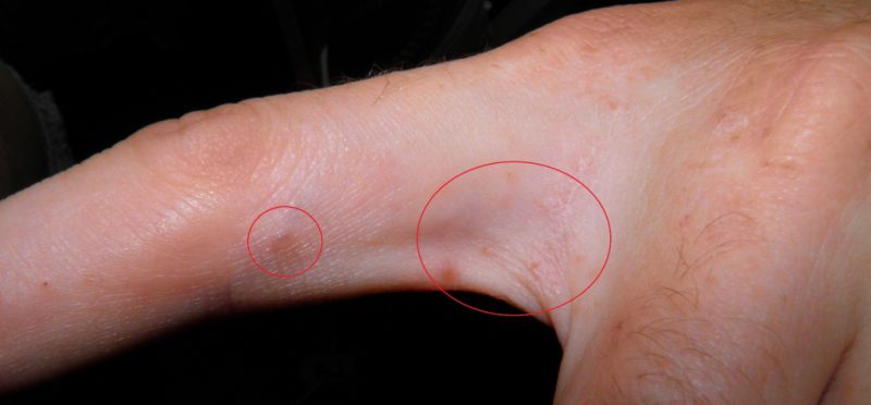 Симптомы проявления чесотки