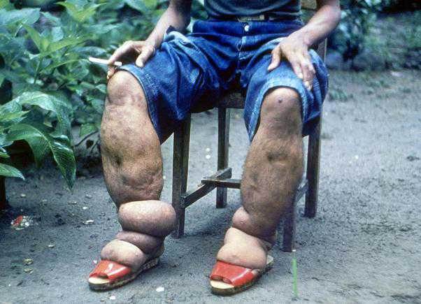 слоновая нога